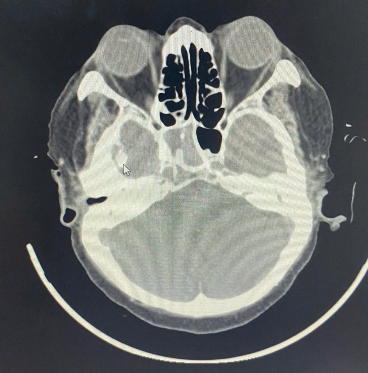 Hình ảnh chụp cắt lớp vi tính viêm xoang bướm bên phải