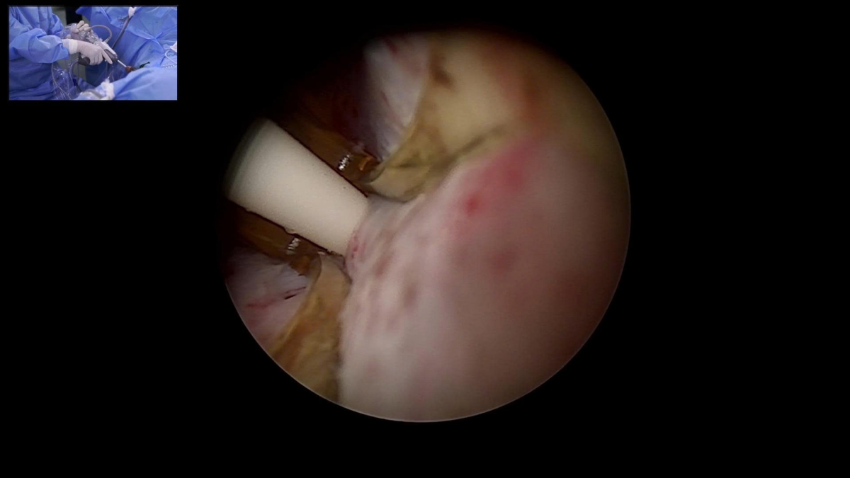 Nội soi trong quá trình thực hiện liệu pháp nhiệt hơi nước (Rezūm) tại Bệnh viện Bạch Mai