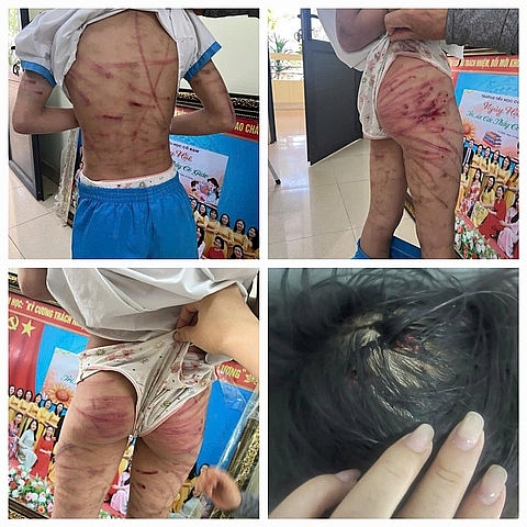 Cháu M bị thương tích nghiêm trọng sau khi bị cha dượng bạo hành