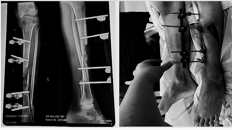 Bệnh viện Quân y 175: Phẫu thuật thành công khuyết hổng xương chày bằng kỹ thuật vi phẫu