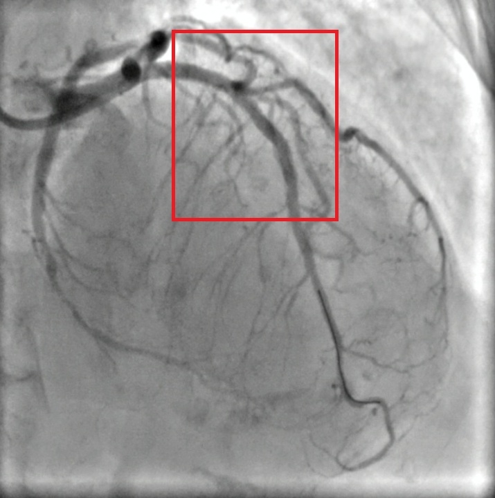 Hình ảnh của bệnh nhân được chụp lại sau khi các y, bác sỹ Bệnh viện đa khoa thành phố Vinh can thiệp y khoa cứu sống người bệnh