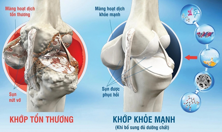 Giữ gìn hệ xương khớp từ sớm - nền tảng để sống khỏe khi về già