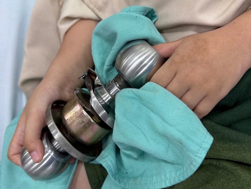 Bé trai N.M.T vào Bệnh viện Chấn thương chỉnh hình trong tình trạng ngón cái kẹt vào ổ khoá