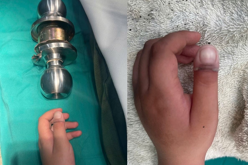 Ngón tay được lấy ra khỏi ổ khóa trong tình trạng dập phần mềm đốt xa, ngón tay hồng ấm