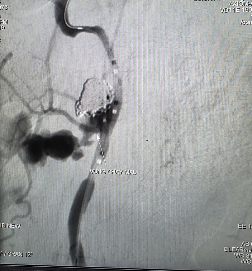 Bệnh viện Đa khoa Trung ương Cần Thơ cứu sống bệnh nhân xuất huyết nguy kịch