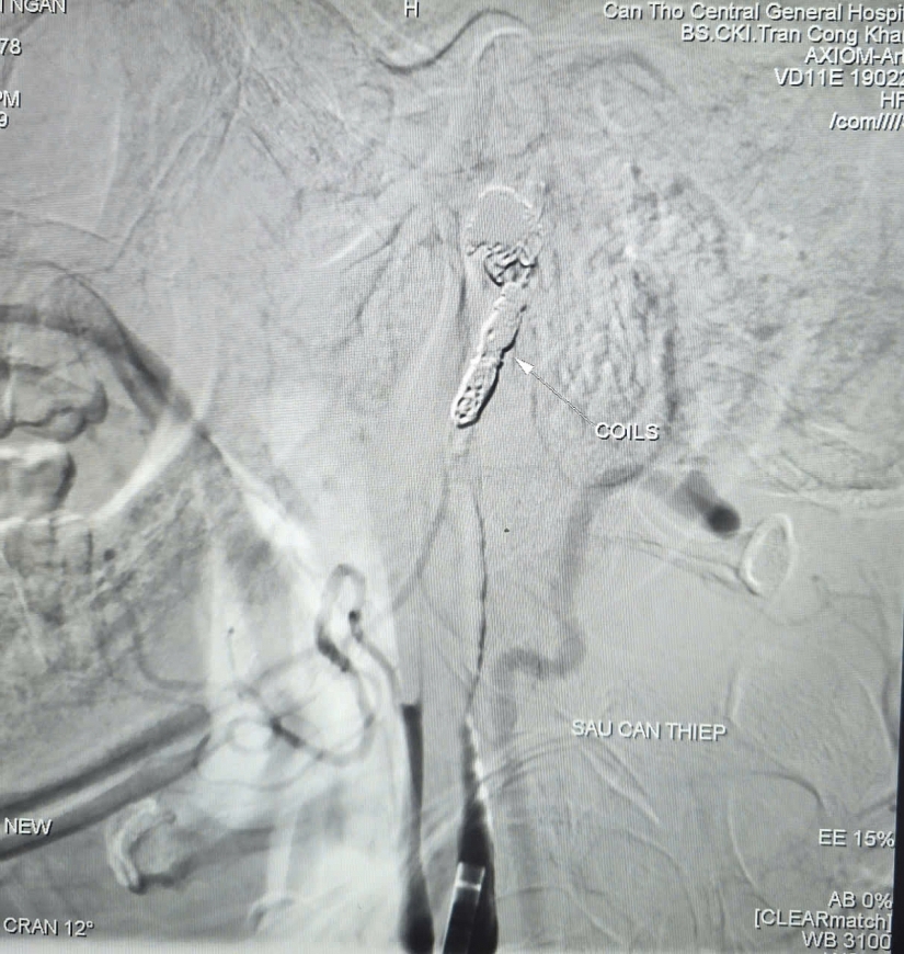 Bệnh viện Đa khoa Trung ương Cần Thơ cứu sống bệnh nhân xuất huyết nguy kịch