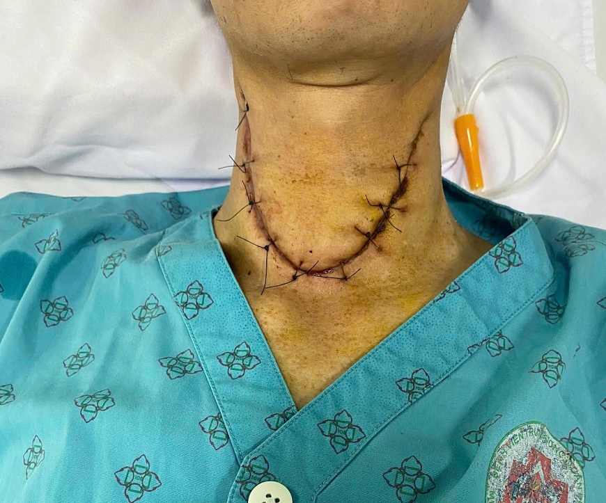 Cứu sống bệnh nhân biến chứng sau áp xe amidan