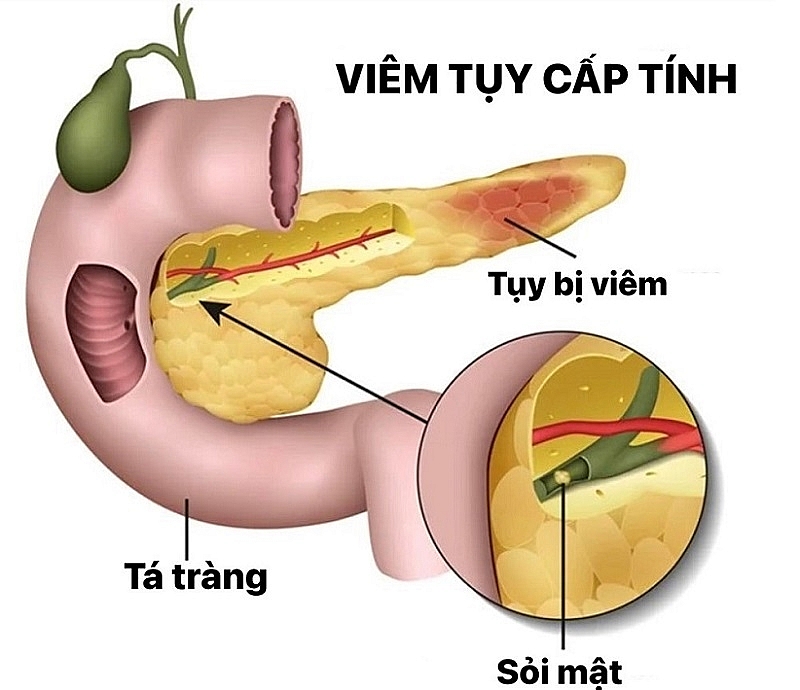 viêm tụy cấp do tăng triglycerid - một nguyên nhân ít gặp nhưng dễ bị bỏ sót - đang có xu hướng gia tăng, đặc biệt ở người có rối loạn chuyển hóa