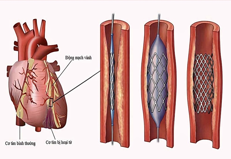 Đặt sten động mạch vành giúp bệnh nhân tái thông dòng máu nuôi tim