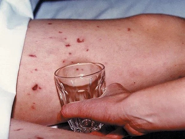 Dấu hiệu của Não mô cầu