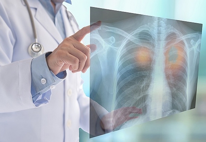 Ung thư phổi vẫn là một trong những nguyên nhân gây tử vong hàng đầu 