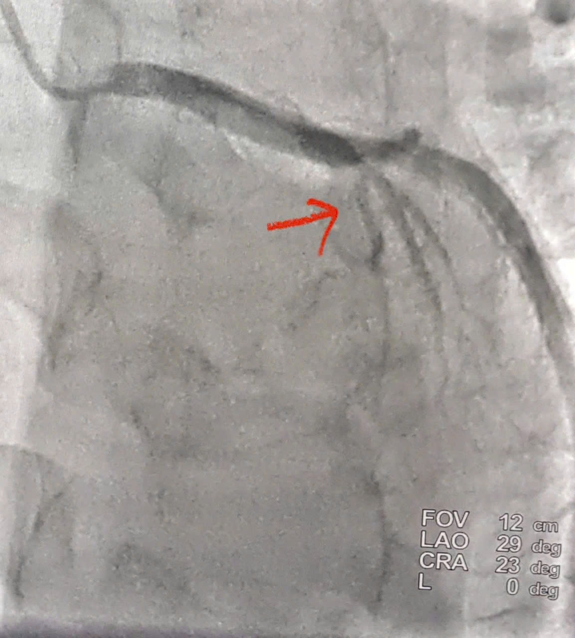 Hình ảnh tắc động mạch liên thất trước đoạn 2 (LADII) (Hình mũi tên đỏ) khi nhập viện tại Bệnh viện đa khoa Nghệ An
