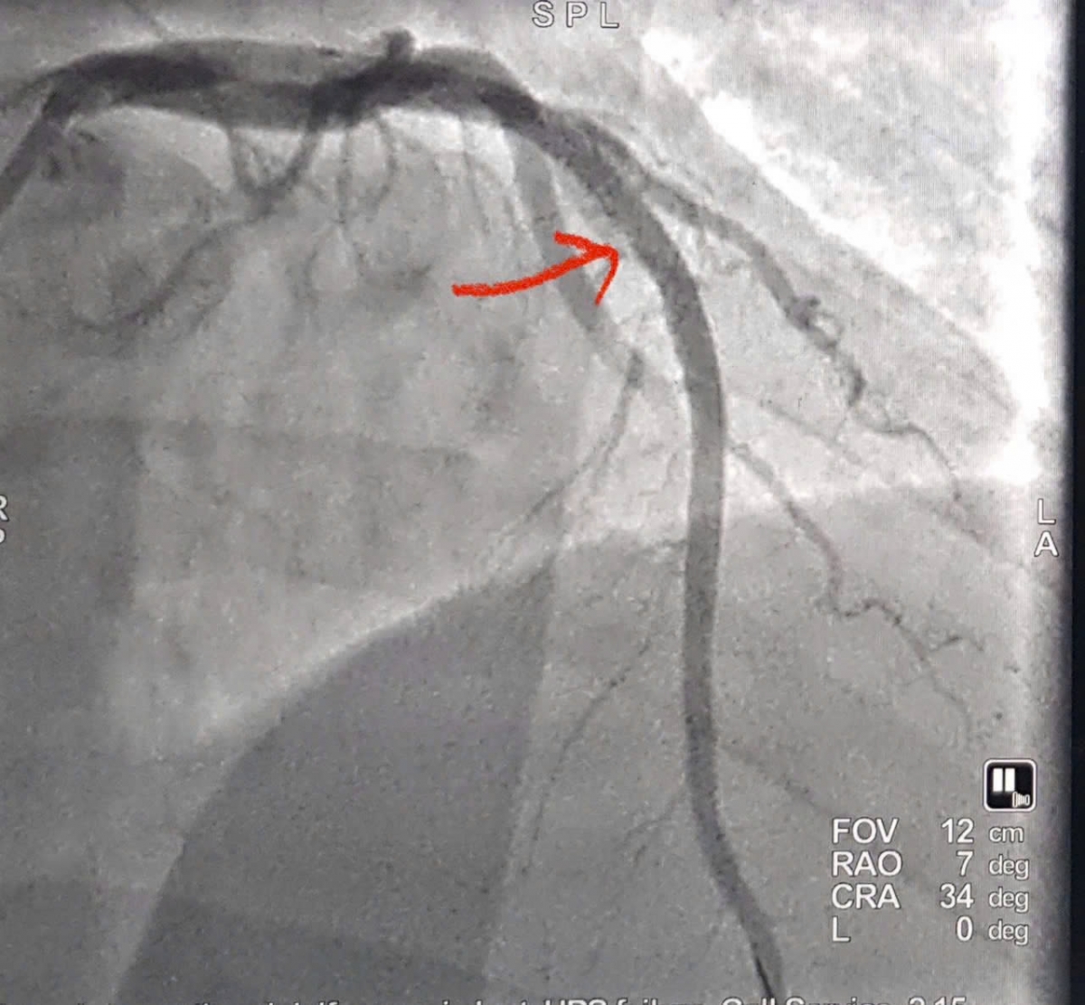 Can thiệp mạch vành trong “giờ vàng” cứu sống bệnh nhân nhồi máu cơ tim cấp người nước ngoài