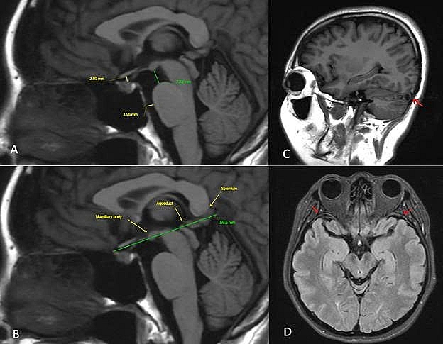 MRI sọ não lần 3 ghi nhận nhiều dấu hiệu gợi ý hội chứng giảm áp lực nội sọ do rò dịch não tủy, bao gồm: não sa thấp nhẹ, các khoang dịch quanh não thu hẹp, giãn các xoang tĩnh mạch nội sọ và dày nhẹ màng não. 