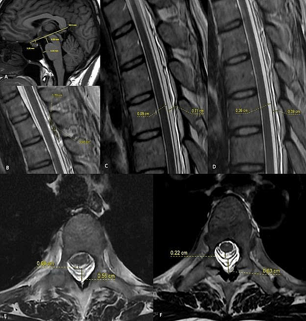 Hình ảnh MRI trước và sau thủ thuật vá máu ngoài màng cứng (EBP). Sau điều trị, khoang chứa dịch não tủy quanh tủy sống được mở rộng trở lại, trong khi khoang ngoài màng cứng thu hẹp rõ rệt. Những thay đổi này cho thấy áp lực dịch não tủy đã được cải thiện sau thủ thuật. 