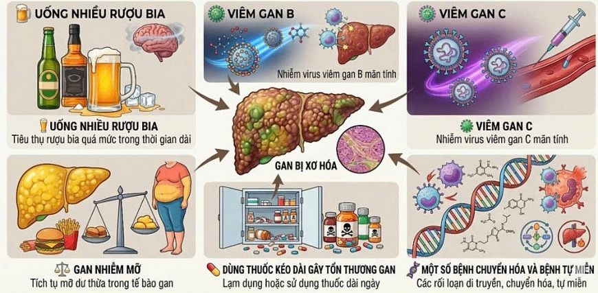 Người bệnh xơ gan cần có lối sống lành mạnh