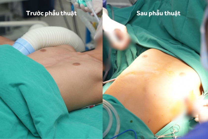 Vinmec Hải Phòng “hồi sinh” lồng ngực bị lõm cho cậu bé 13 tuổi bằng ca phẫu thuật tạo hình phức tạp Vinmec Hải Phòng “hồi sinh” lồng ngực bị lõm cho cậu bé 13 tuổi bằng ca phẫu thuật tạo hình phức tạp