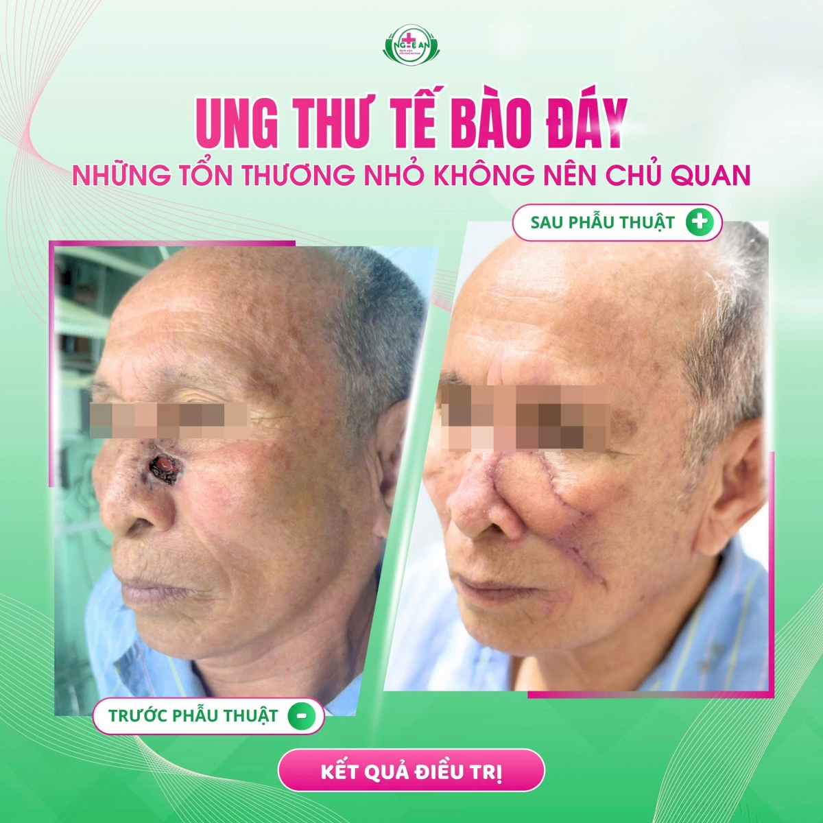 Người cao tuổi thường hay có những thay đổi về da, vì vậy không nên chủ quan. Người cao tuổi thường hay có những thay đổi về da, vì vậy không nên chủ quan.