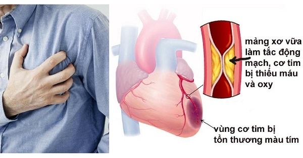 Cơn đau thắt ngực là dấu hiệu thường gặp và là triệu chứng điển hình của bệnh động mạch vành. Cơn đau thắt ngực là dấu hiệu thường gặp và là triệu chứng điển hình của bệnh động mạch vành.