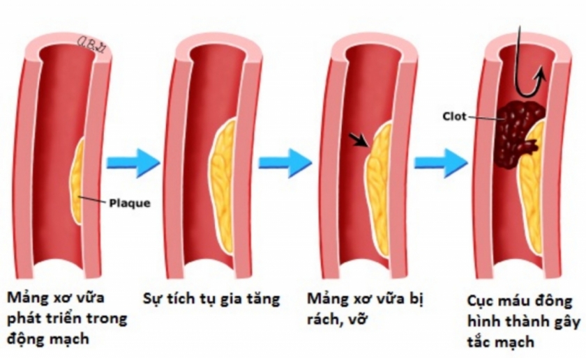 Cơn đau thắt ngực là dấu hiệu thường gặp và là triệu chứng điển hình của bệnh động mạch vành. Cơn đau thắt ngực là dấu hiệu thường gặp và là triệu chứng điển hình của bệnh động mạch vành.