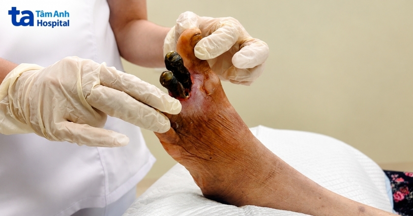 Ngâm chân nước nóng, người bệnh đái tháo đường có thể mất chân
