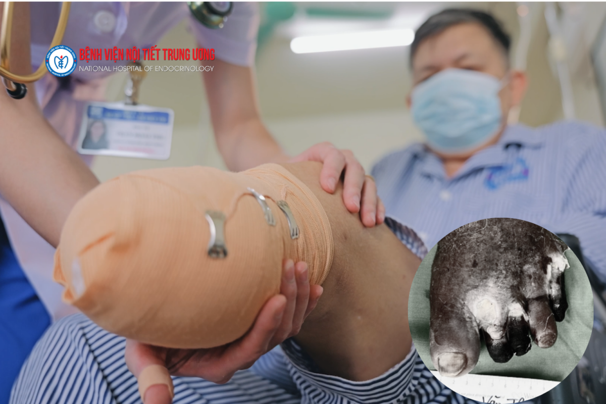 Ngâm chân nước nóng, người bệnh đái tháo đường có thể mất chân
