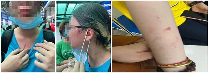 Một số học sinh bị thương sau vụ xô xát. Ảnh: PHCC.