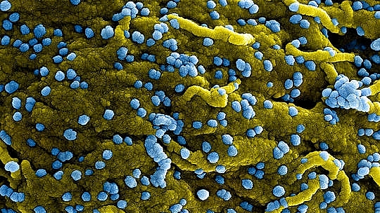 Hình ảnh hiển vi điện tử quét màu của các hạt virus Marburg (màu xanh lam) dính vào bề mặt của các tế bào VERO E6 bị nhiễm bệnh (màu vàng). Ảnh: Getty Images