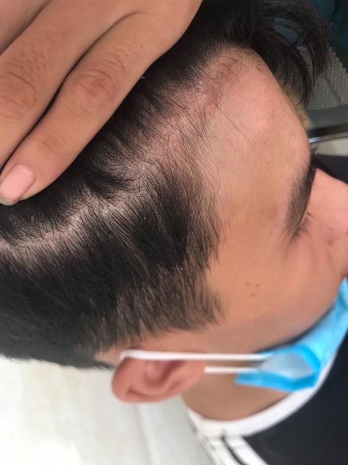 Cháu Nguyễn Văn Bảo điều trị tại Bệnh viện Hợp lực, với vết thâm tím trên đầu