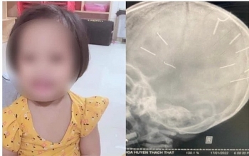 Bé gái 3 tuổi bị đinh găm vào đầu đã tử vong sau gần 2 tháng điều trị