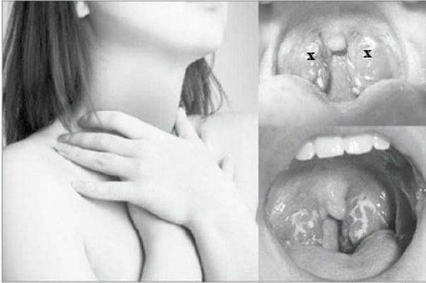 Hình ảnh amidan bị viêm (x).