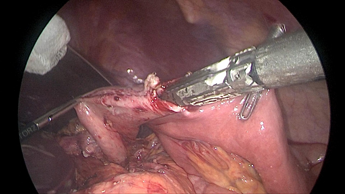 Phẫu thuật nội soi hoàn toàn: Giải pháp tối ưu trong điều trị ung thư dạ dày, đại tràng