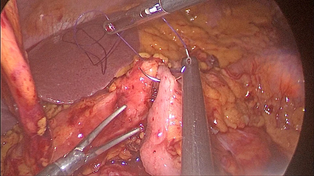 Phẫu thuật nội soi hoàn toàn: Giải pháp tối ưu trong điều trị ung thư dạ dày, đại tràng