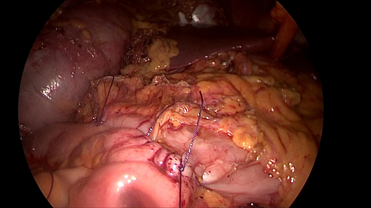 Phẫu thuật nội soi hoàn toàn: Giải pháp tối ưu trong điều trị ung thư dạ dày, đại tràng