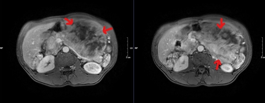 GIST dạ dày - Căn bệnh lành tính để muộn thành ung thư GIST dạ dày - Căn bệnh lành tính để muộn thành ung thư