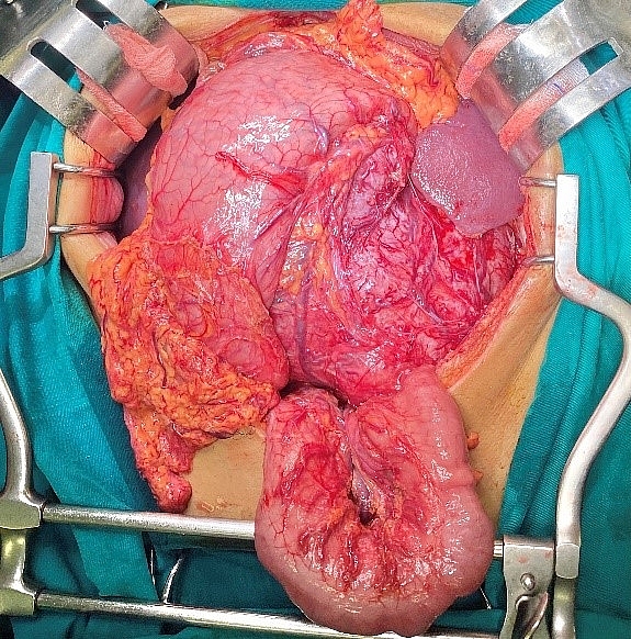 GIST dạ dày - Căn bệnh lành tính để muộn thành ung thư GIST dạ dày - Căn bệnh lành tính để muộn thành ung thư