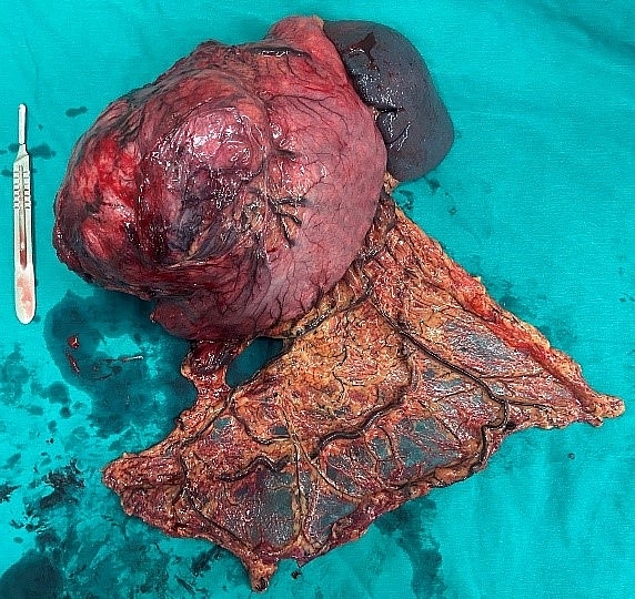 GIST dạ dày - Căn bệnh lành tính để muộn thành ung thư GIST dạ dày - Căn bệnh lành tính để muộn thành ung thư