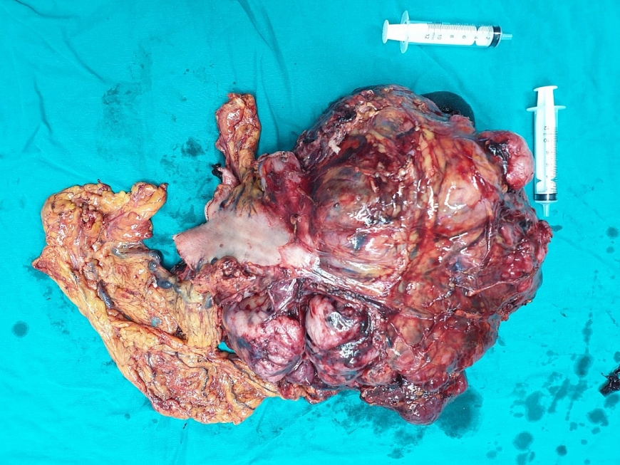 GIST dạ dày - Căn bệnh lành tính để muộn thành ung thư GIST dạ dày - Căn bệnh lành tính để muộn thành ung thư