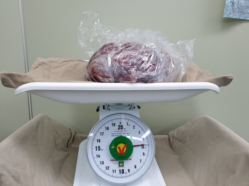 GIST dạ dày - Căn bệnh lành tính để muộn thành ung thư GIST dạ dày - Căn bệnh lành tính để muộn thành ung thư