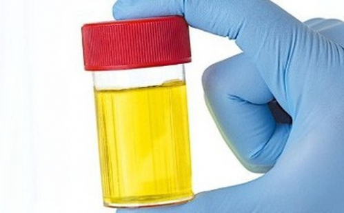 Nước tiểu vàng cảnh báo điều gì liệu bạn đã biết?