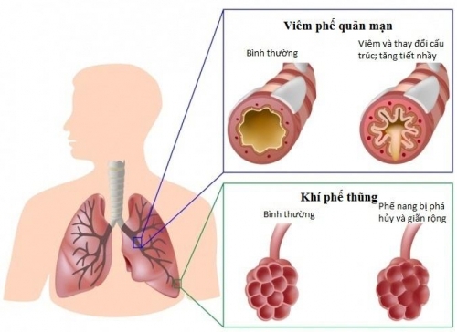 Viêm phế quản co thắt nguyên nhân, triệu chứng và cách điều trị