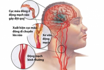 Chủ động phòng đột qụy não