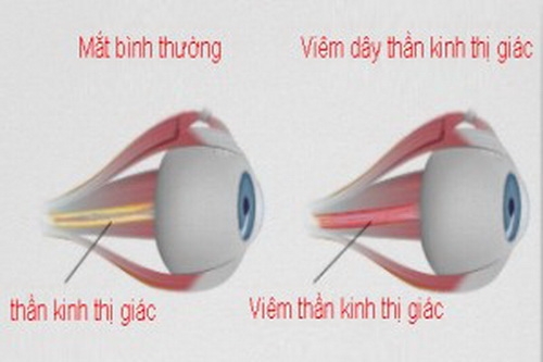 Viêm dây thần kinh thị giác: Dễ giảm thị lực không phục hồi