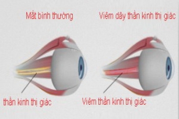 Viêm dây thần kinh thị giác: Dễ giảm thị lực không phục hồi