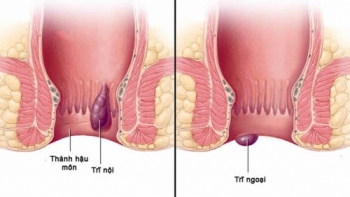 Chế độ sinh hoạt hợp lí người mắc bệnh trĩ cần biết