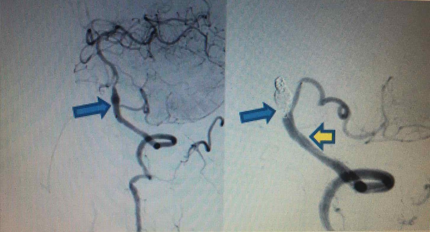 H&igrave;nh ảnh trước v&agrave; sau can thiệp (tr&aacute;i: Ph&igrave;nh h&igrave;nh thoi b&oacute;c t&aacute;ch động mạch) v&agrave; (phải: Đặt stent động mạch đốt sống - PICA tr&aacute;i v&agrave; b&iacute;t coils tắc ho&agrave;n to&agrave;n ph&igrave;nh h&igrave;nh thoi)