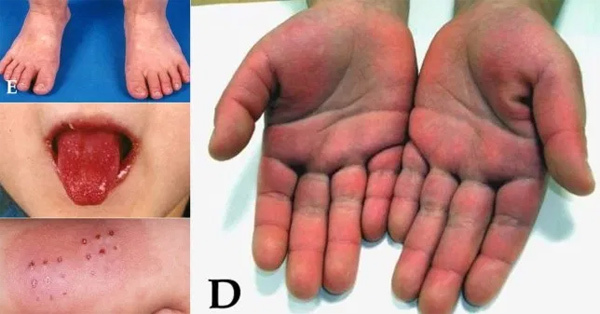 Biến chứng lạ ở ba b&eacute; mắc Covid-19 tại Mỹ