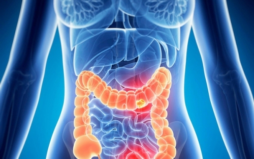 5 loại thực phẩm ăn nhiều dễ mắc ung thư ruột