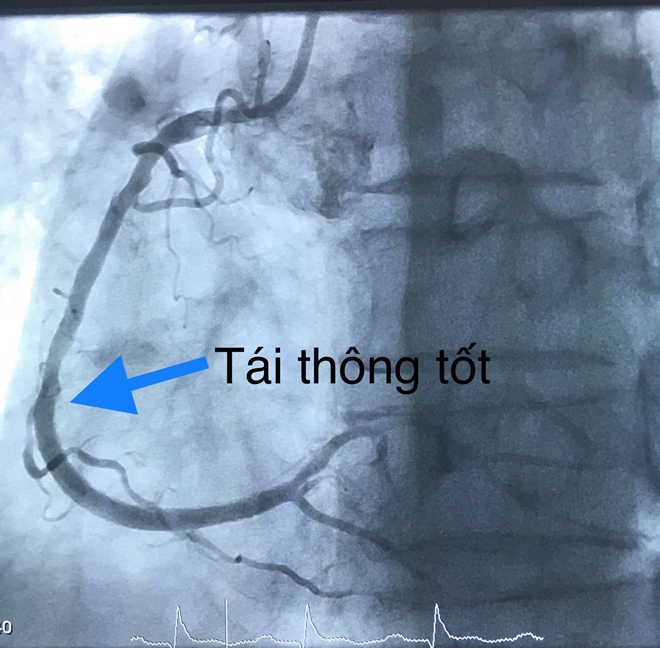 Cứu sống cụ ông nhồi máu cơ tim, ngưng tim, ngưng thở