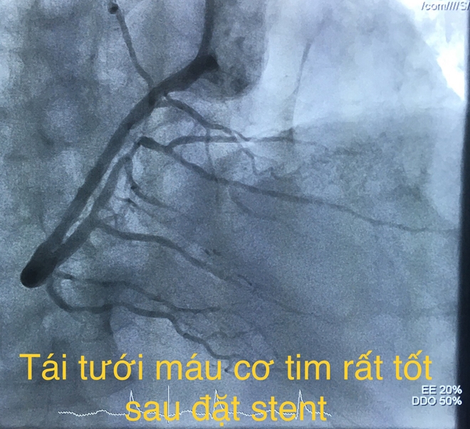V&agrave; sau khi được t&aacute;i th&ocirc;ng.
